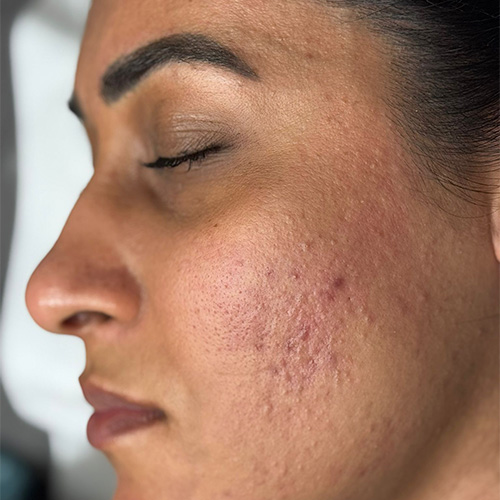 micro 2nd side after