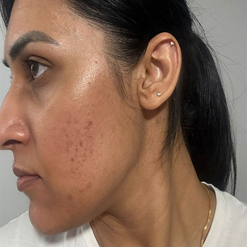 micro 2nd side before